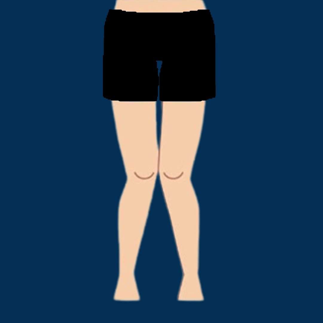 Knock Knee Deformity
