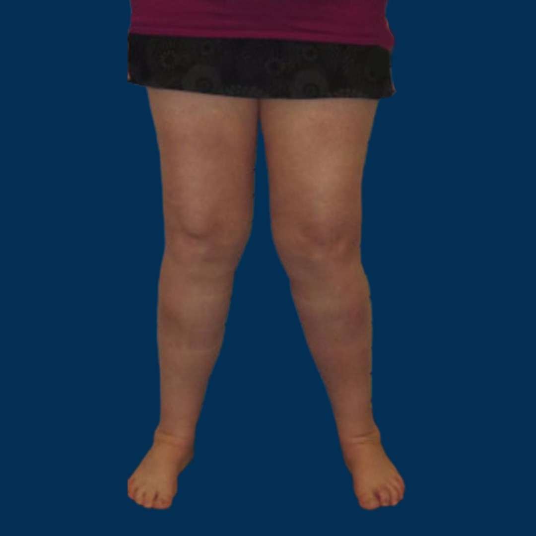 Knock Knee Treatment