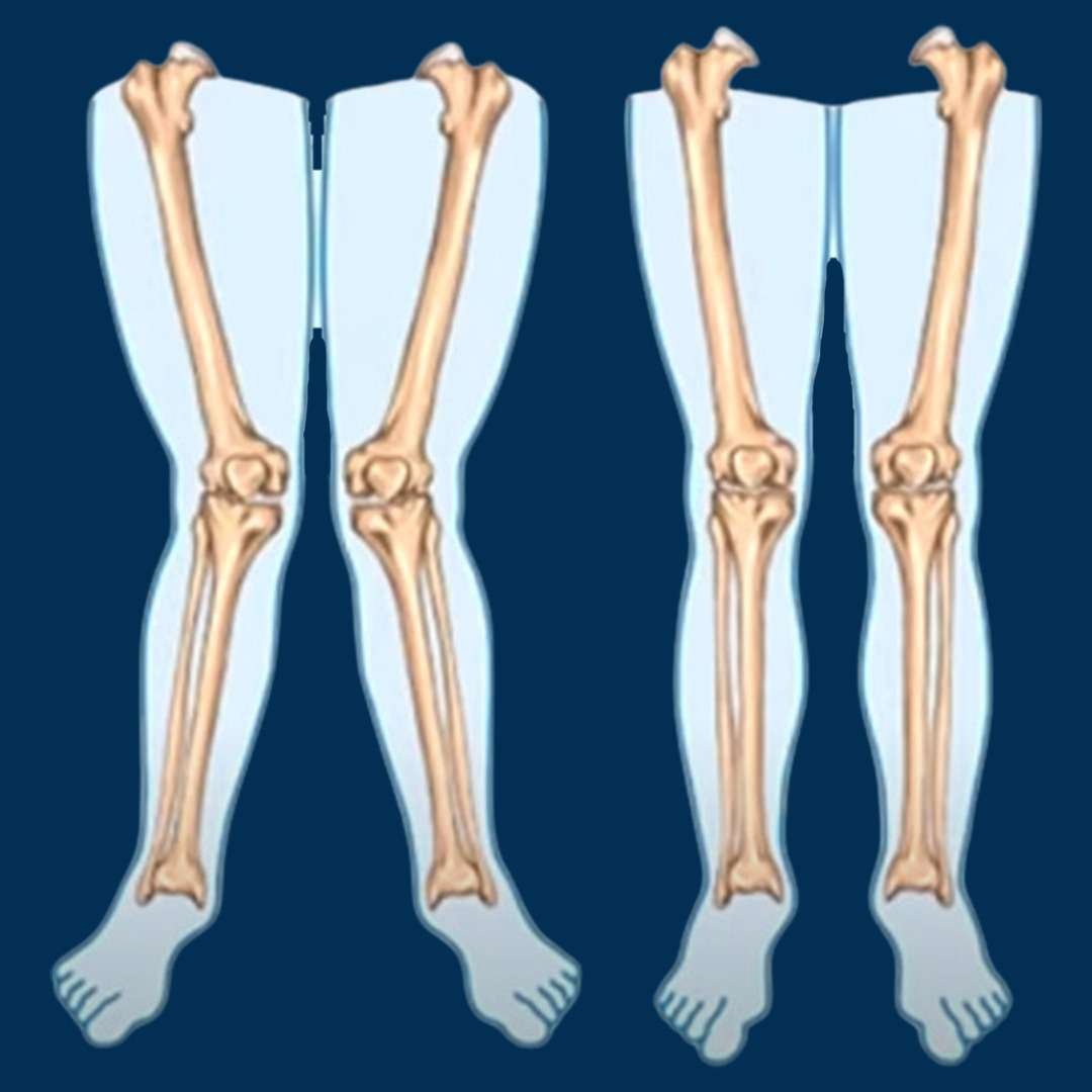 What is Knock Knee