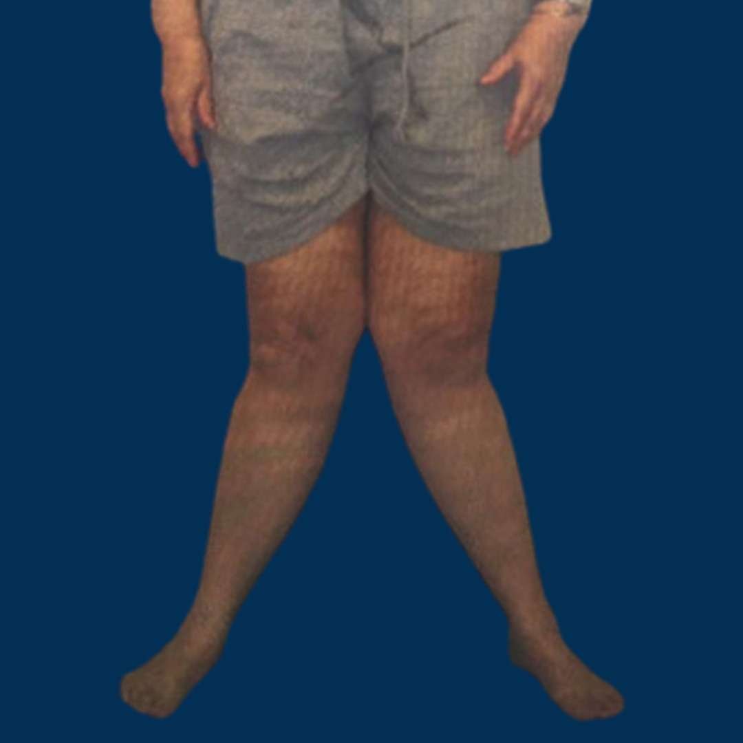 genu valgum